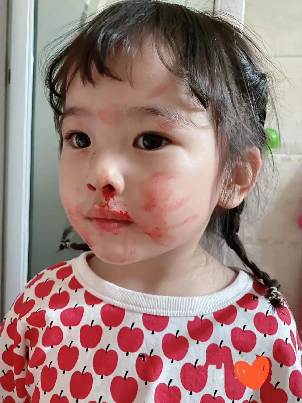 救命！3岁娃反复流鼻血愁死妈！跑遍诊所都说正常，可血还是三天两头哗哗流😭 纸巾