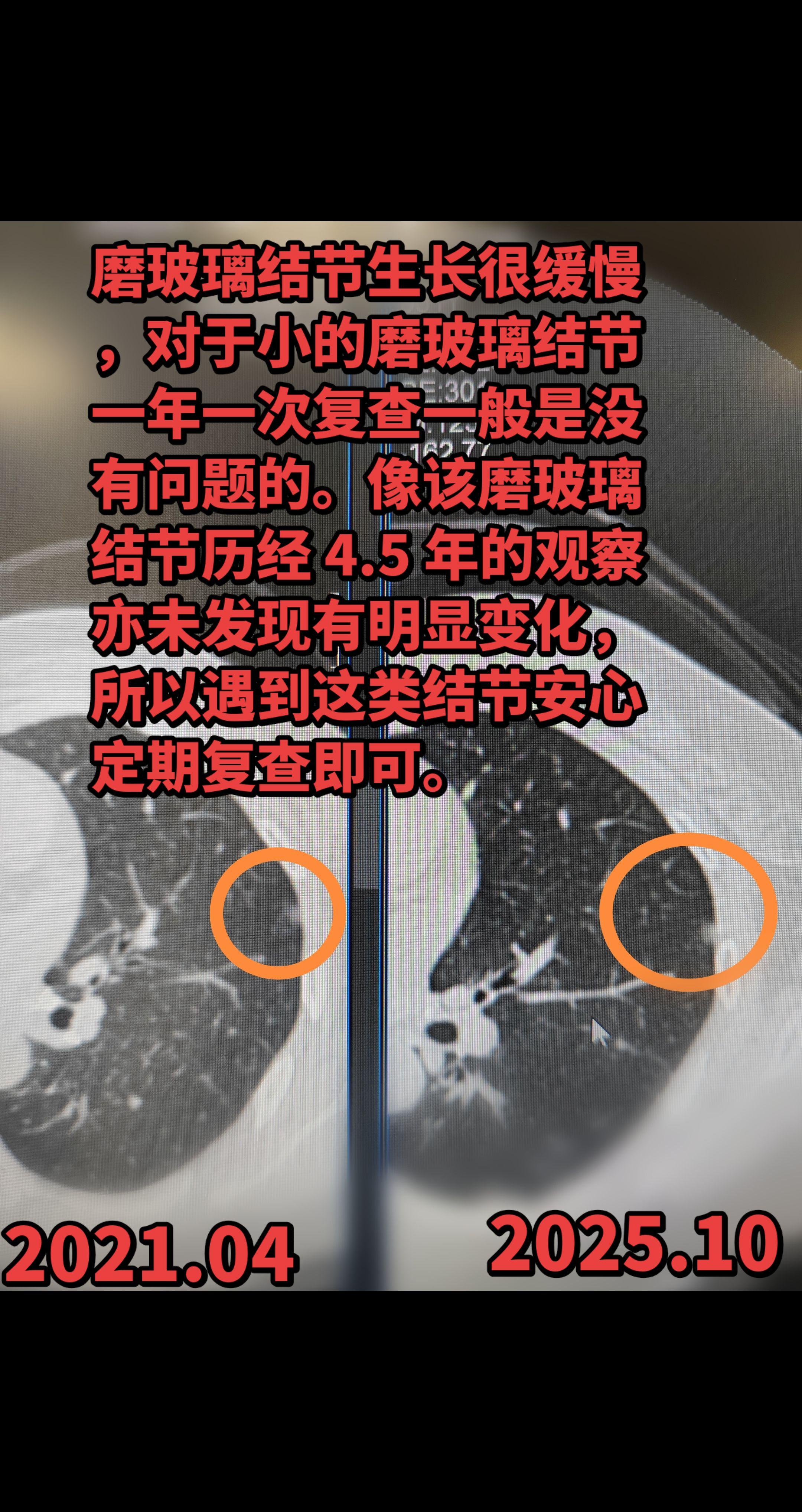 小的纯磨玻璃结节年度复查即可。磨玻璃结节生长很缓慢，对于小的磨玻璃结节...