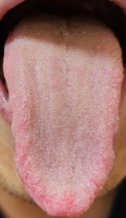 排尿不畅，每次排尿只排出了几滴，甚至有的时候排不出来，张医生一则案例告诉你。
李