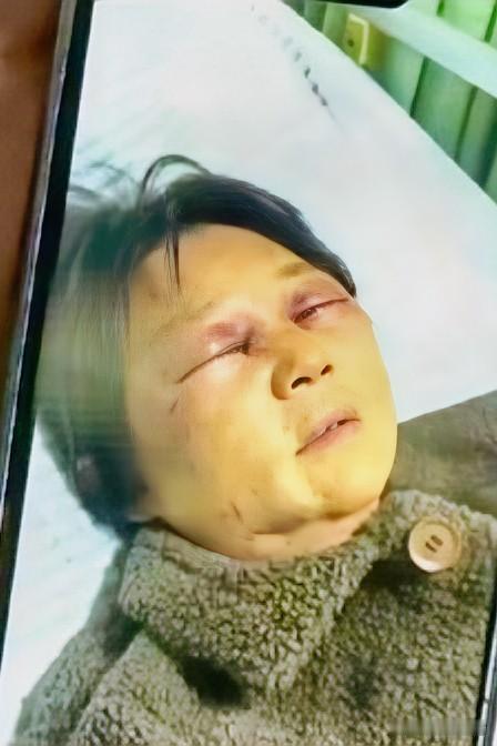 六旬老太太被儿媳妇打断肋骨！

老太太的老伴走后想找个伴安度晚年，就因为不肯帮儿