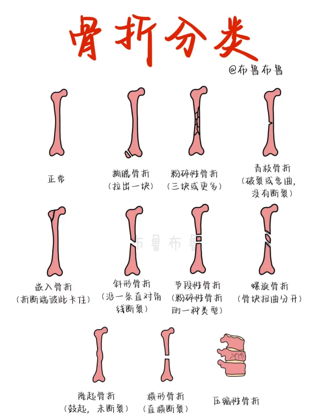 医学生笔记——骨折分类
