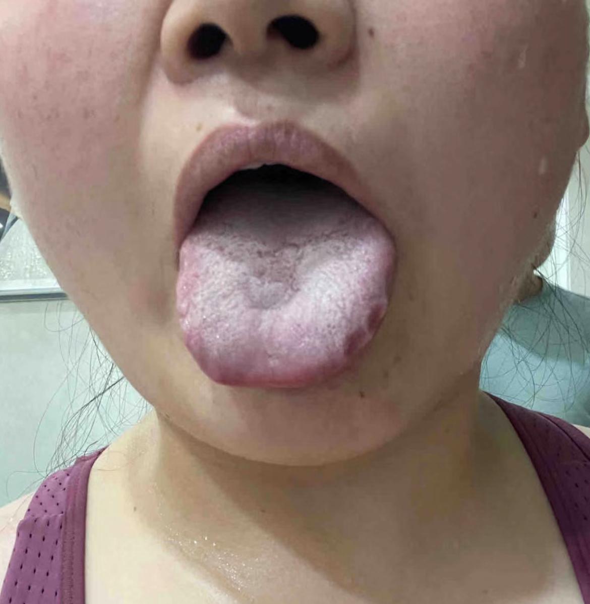 老妹真的不能拖了！就你现在这个状态，再运动，再排汗，再节制，已经为时已晚！

舌