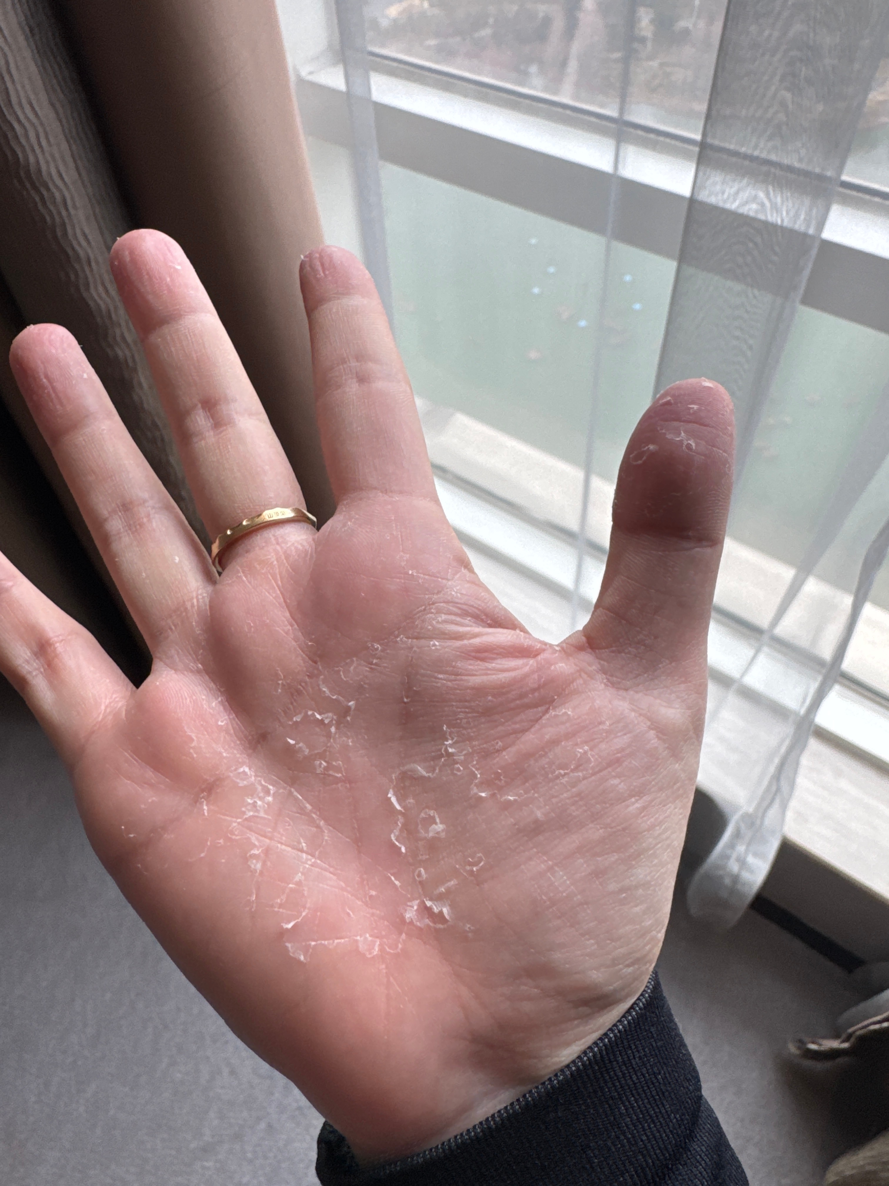 极寒一个月回来的后遗症角质层整体失水手指手掌全都库库掉皮手指甲也全部冻脆了（我还
