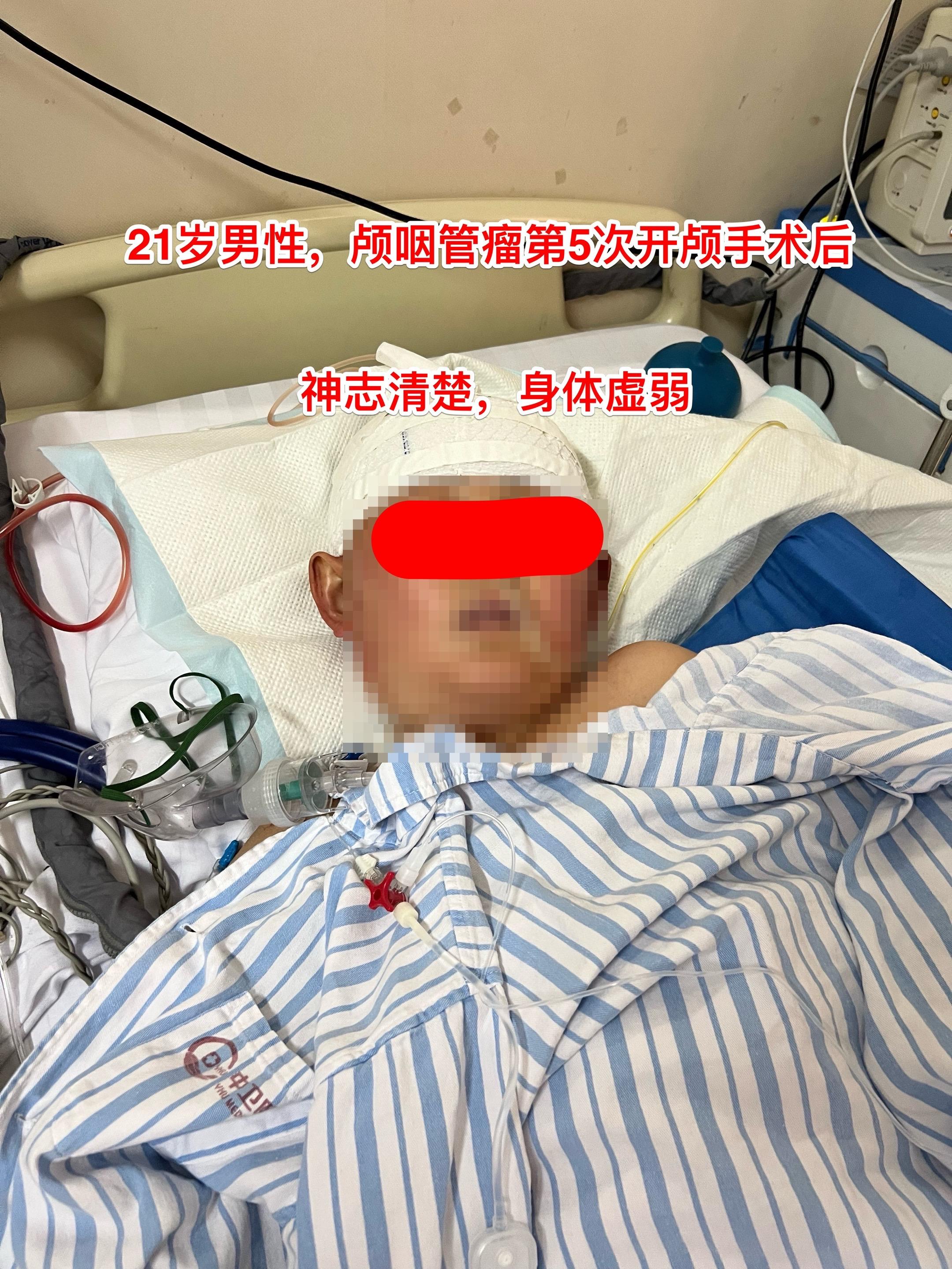 21岁男性颅咽管瘤四次手术后又复发了。还能不能作手术？ 21岁回民，山...