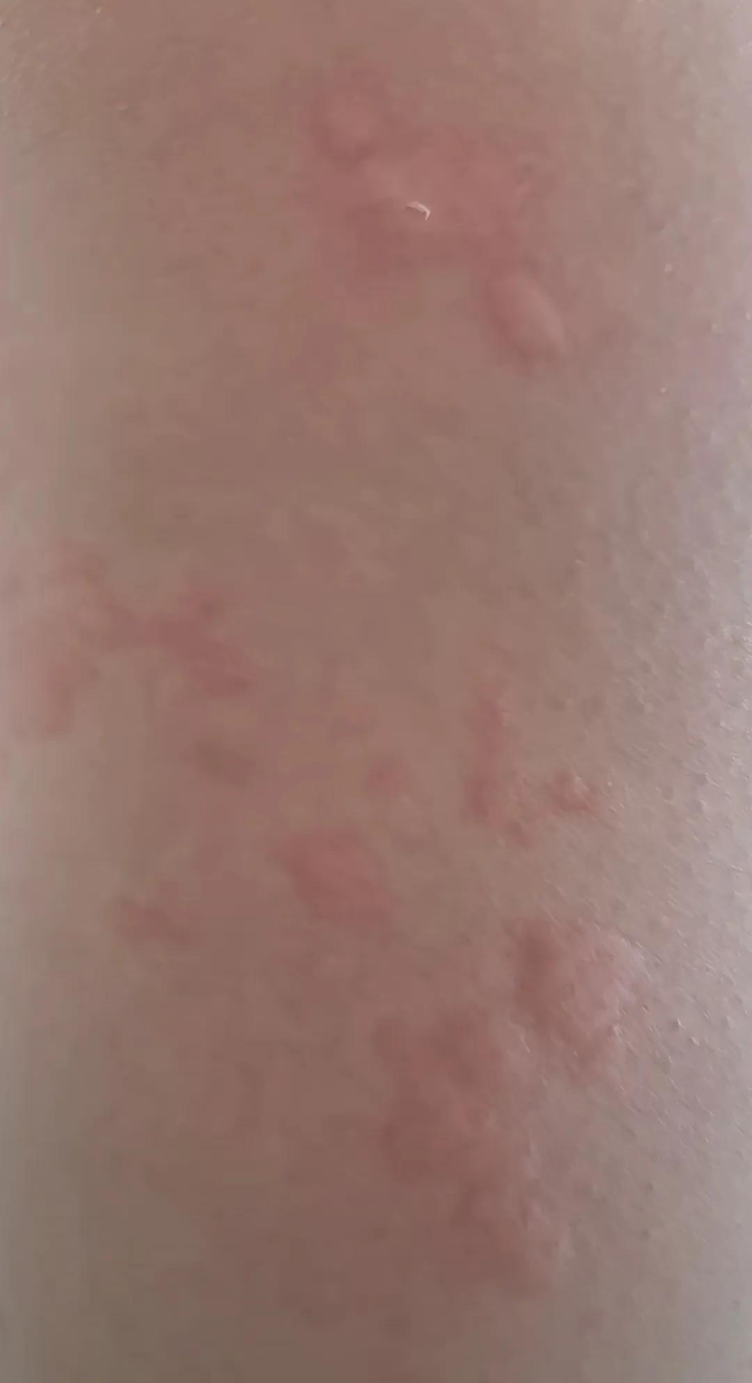 5年前产后抑郁症伴随荨麻疹几乎同时期好了的我，5年没有起荨麻疹也没有抑郁症状！