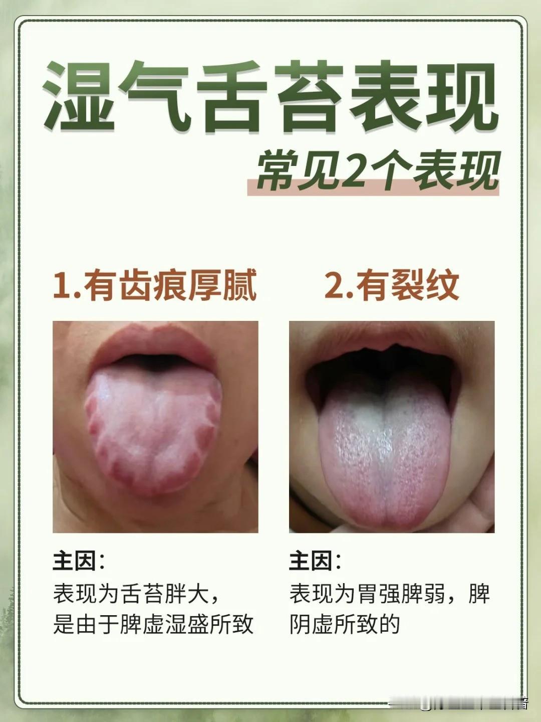 两种脾虚湿气舌苔，你是哪一种？