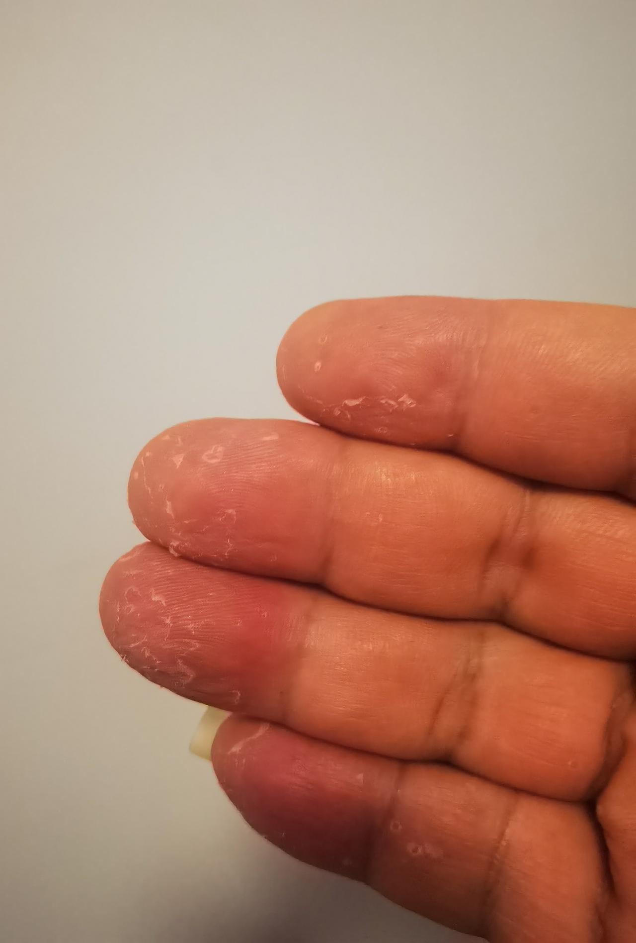 我这手是怎么了？一年一次，现在才刚开始。中间擦了好多药，吃了好多药，都没效果。请