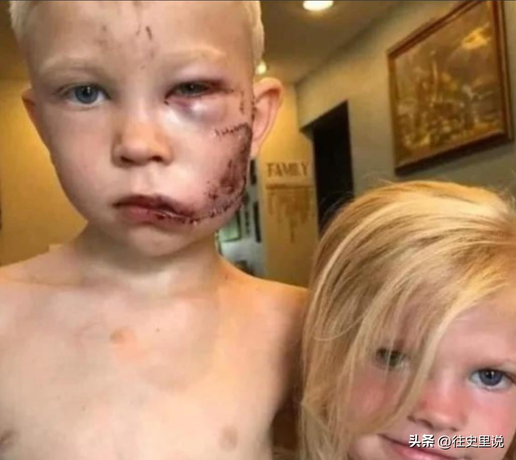 这个小男孩从一只牧羊犬口中救出了他的小妹妹，他全身缝了90针，但把他三岁的妹妹从