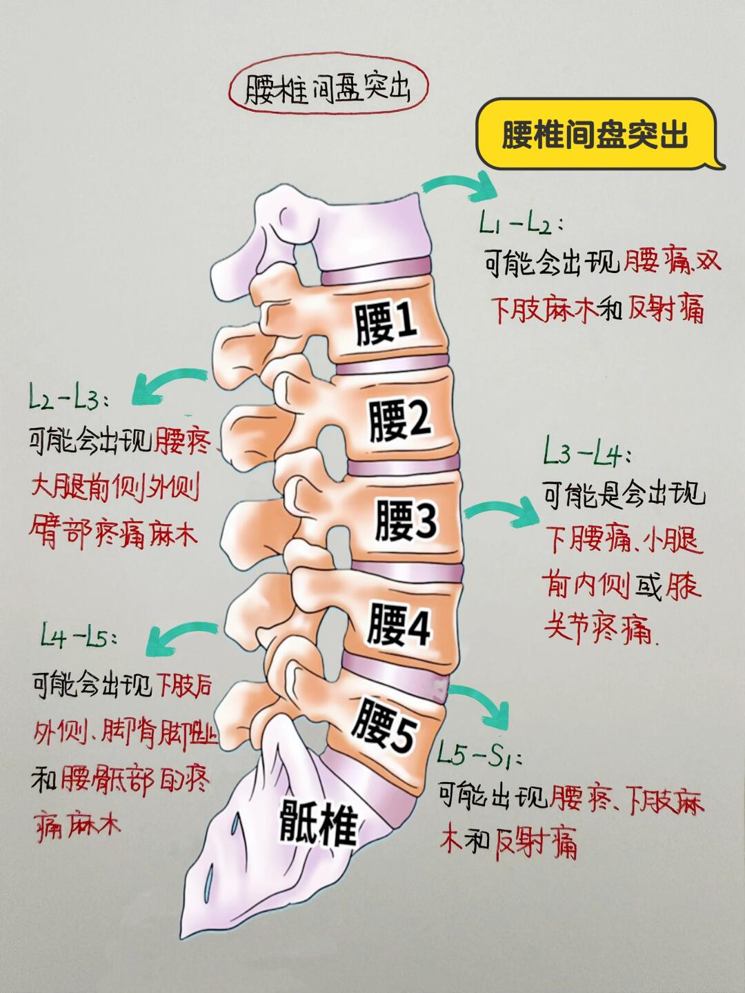 今日学习打卡——腰椎间盘突出