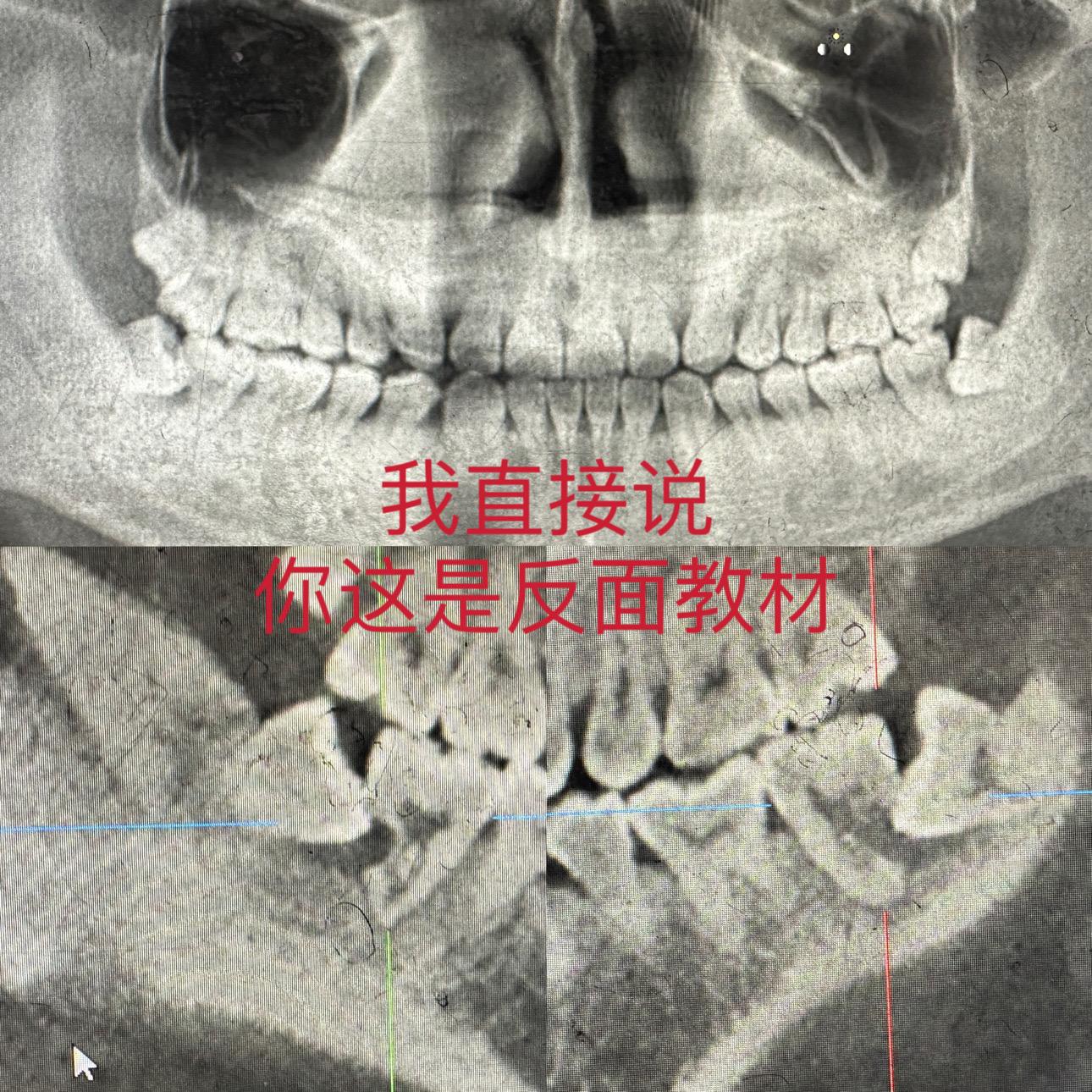 这智齿留的可惜了