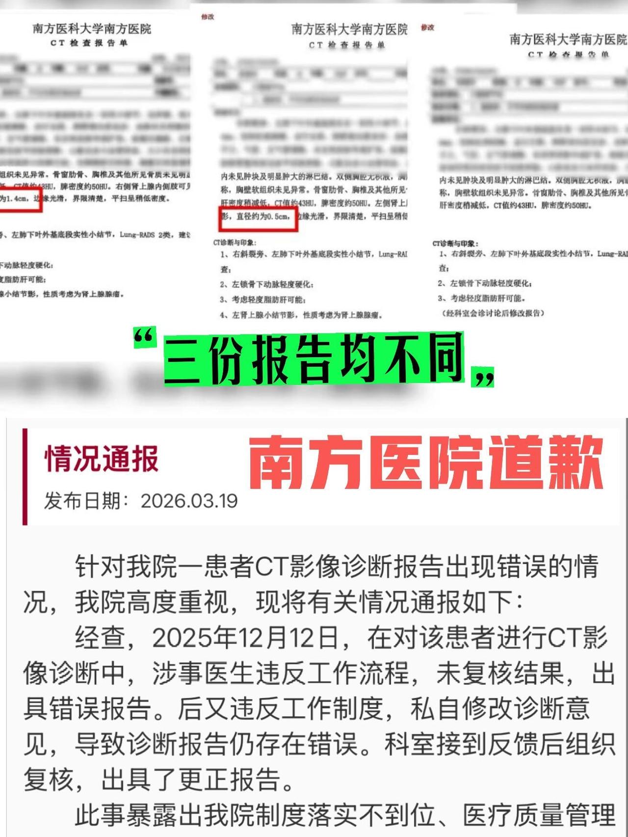 有患者去南方医院做CT检查，医院先后出了三份完全不一样的报告。一开始说患者有肾上