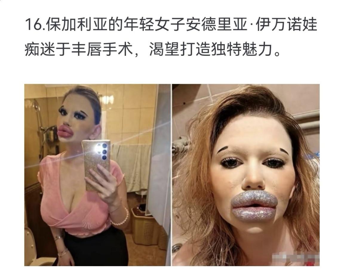 保加利亚的年轻女子安德里亚．伊万诺娃痴迷于丰唇手术，渴望打造独特魅力