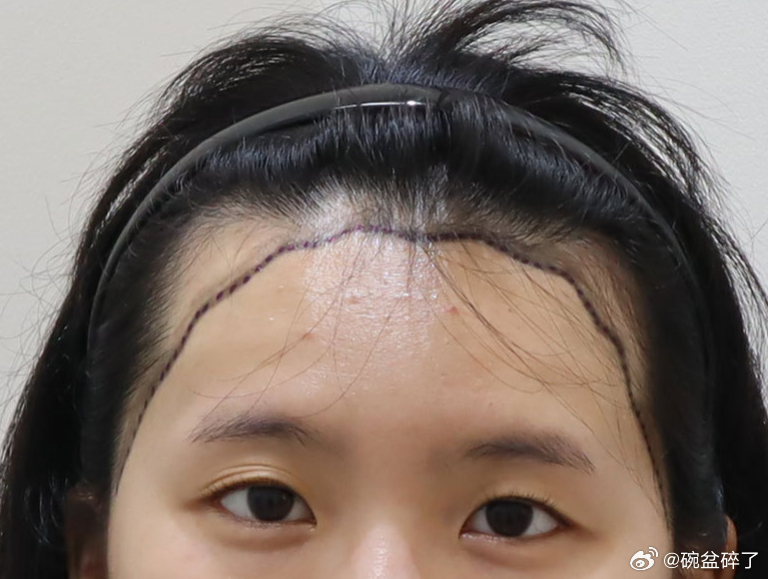 韩国这家植发医院性价比很高，本地评价很不错，从面诊到术后都强调个性化设计，拒绝套