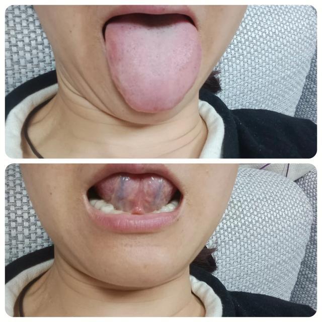舌下青筋粗、发黑，70% 的人一上来就被建议活血化瘀，其实很多时候根本不对症。