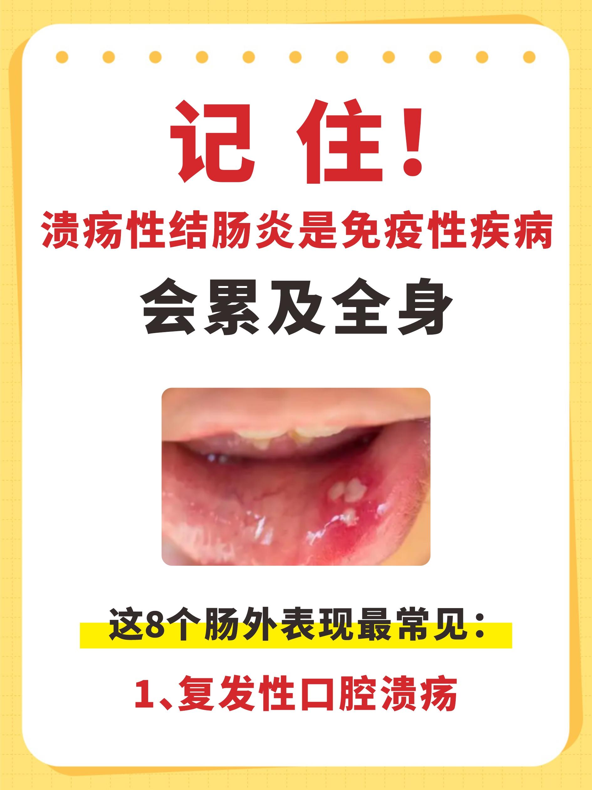 溃疡性结肠炎最常见的8个肠外表现。