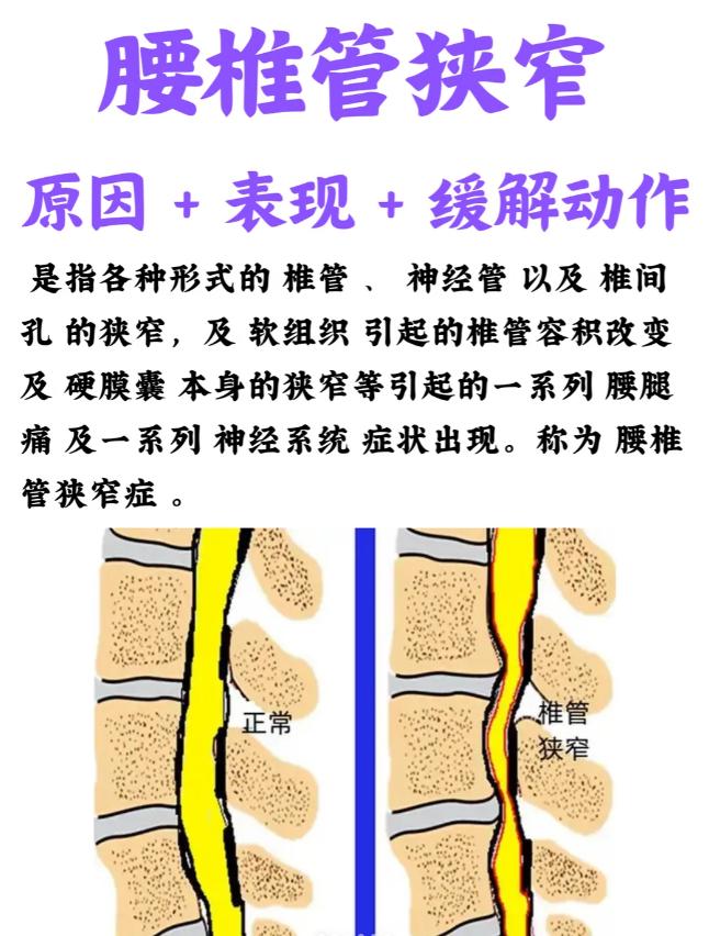 腰椎管狭窄原因表现＋缓解动作 腰椎管狭窄的原因＋表现＋缓解动作 各种形...