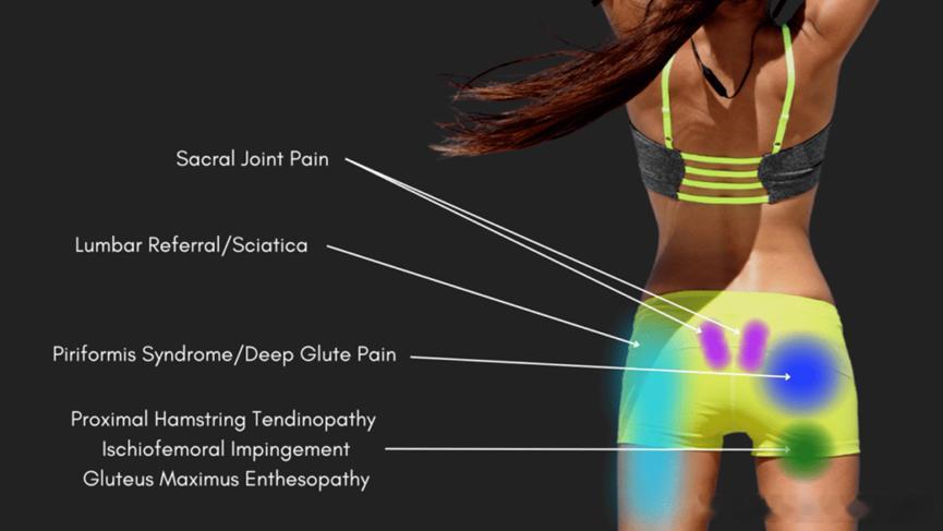 臀部后侧疼痛可能是什么原因  给大家整理一波常见原因⚡️骶髂关节疼痛（Sacra