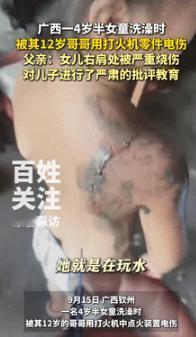 细思极恐！9月17日广西钦州，一4岁半女孩在洗澡时，被哥哥用打火机零件电伤，导致