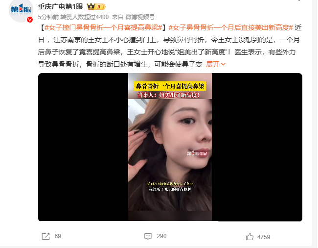 女子鼻骨骨折一个月后直接美出新高度   这是因祸得大福了[允悲]好多人去整都整不