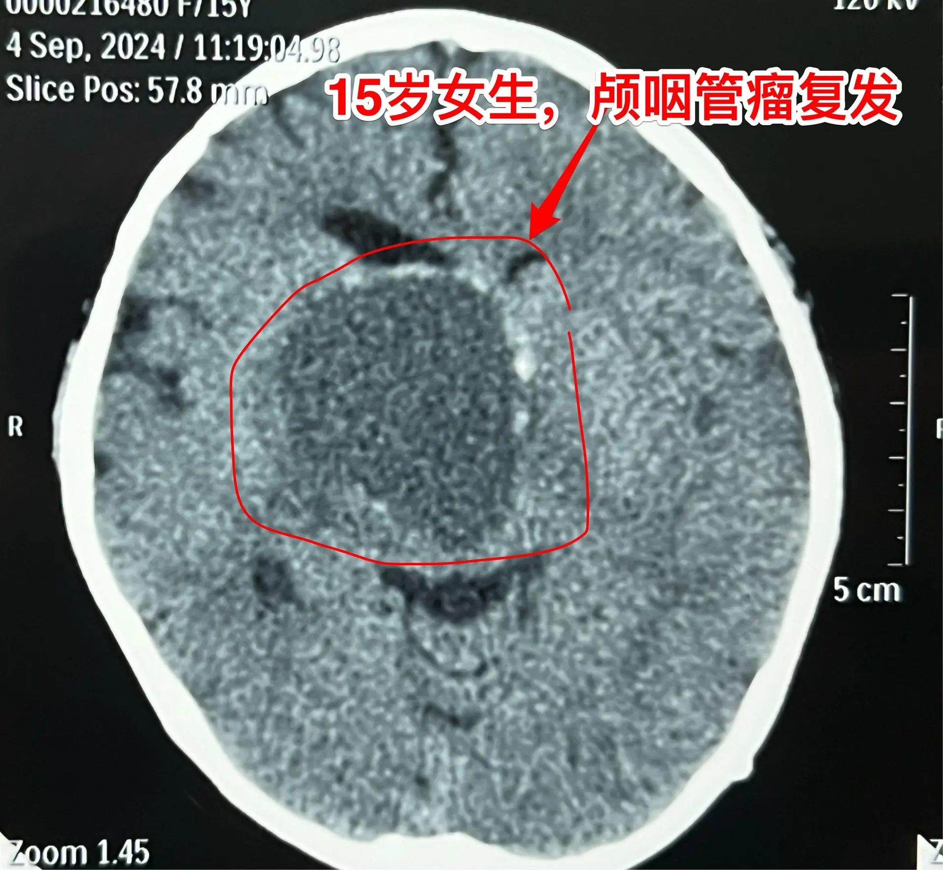 颅咽管瘤不是按匀速生长，进展很难预料。15岁的福建龙岩市女生，因颅咽管...