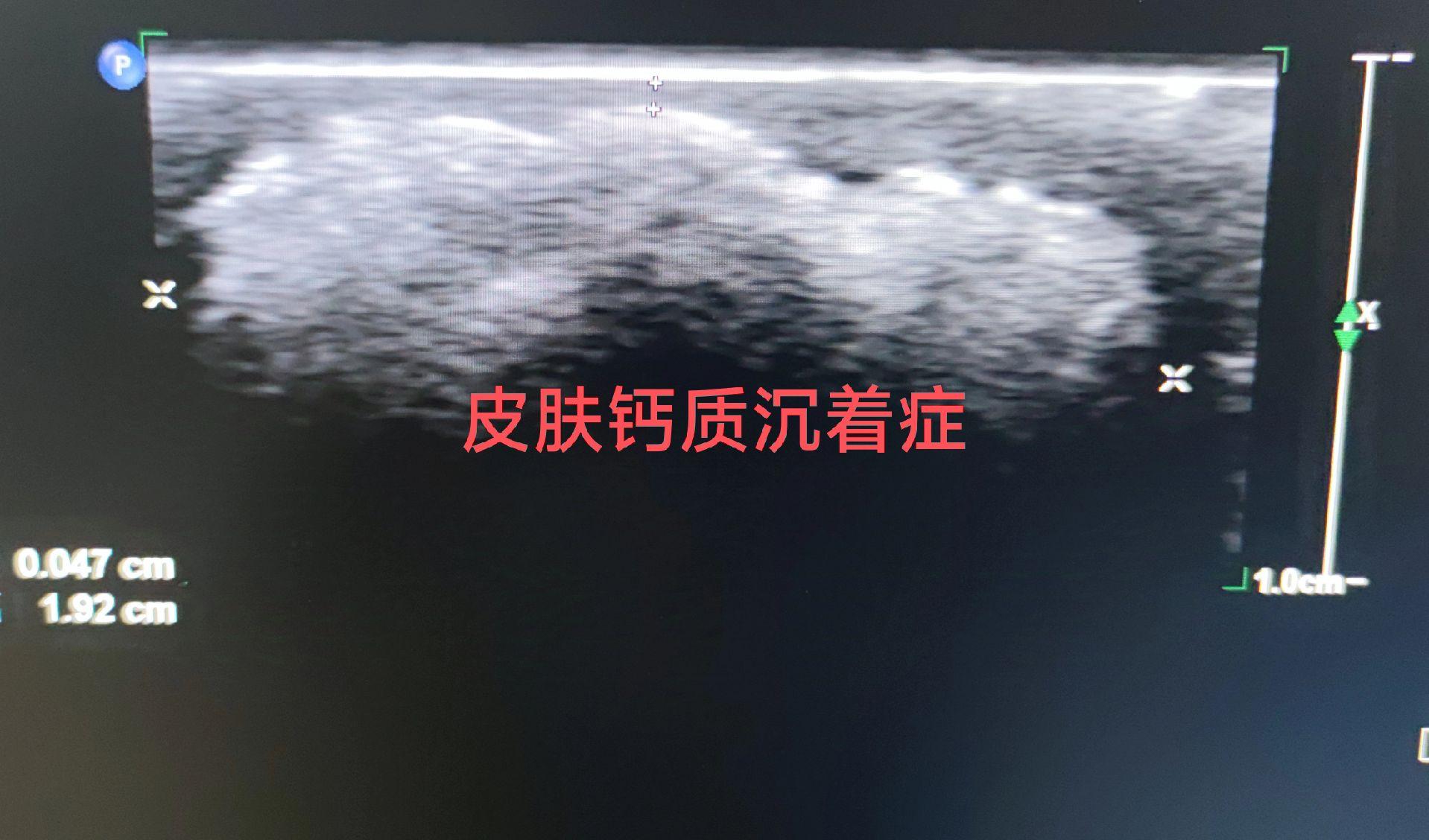 皮肤钙质沉着症超声。老年，自觉皮下包块20年，无血流 与毛母质瘤鉴别...