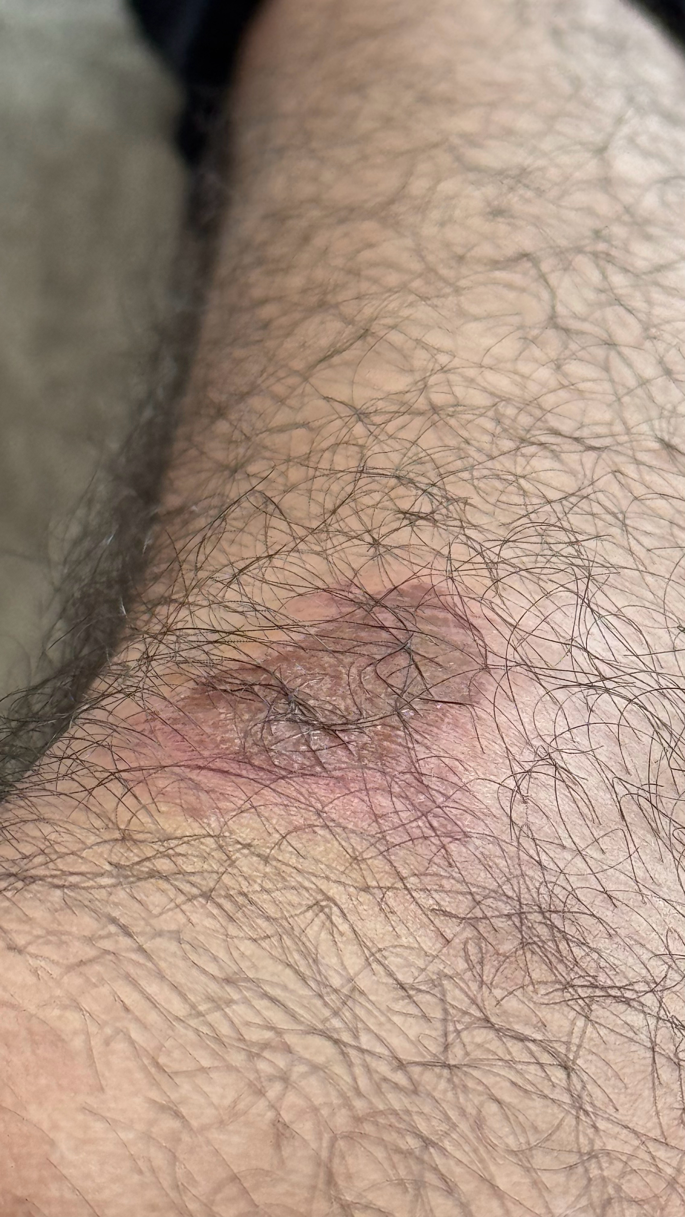 想问一下各位这个伤口结痂掉了之后我这块腿毛还在吗？ ​​​