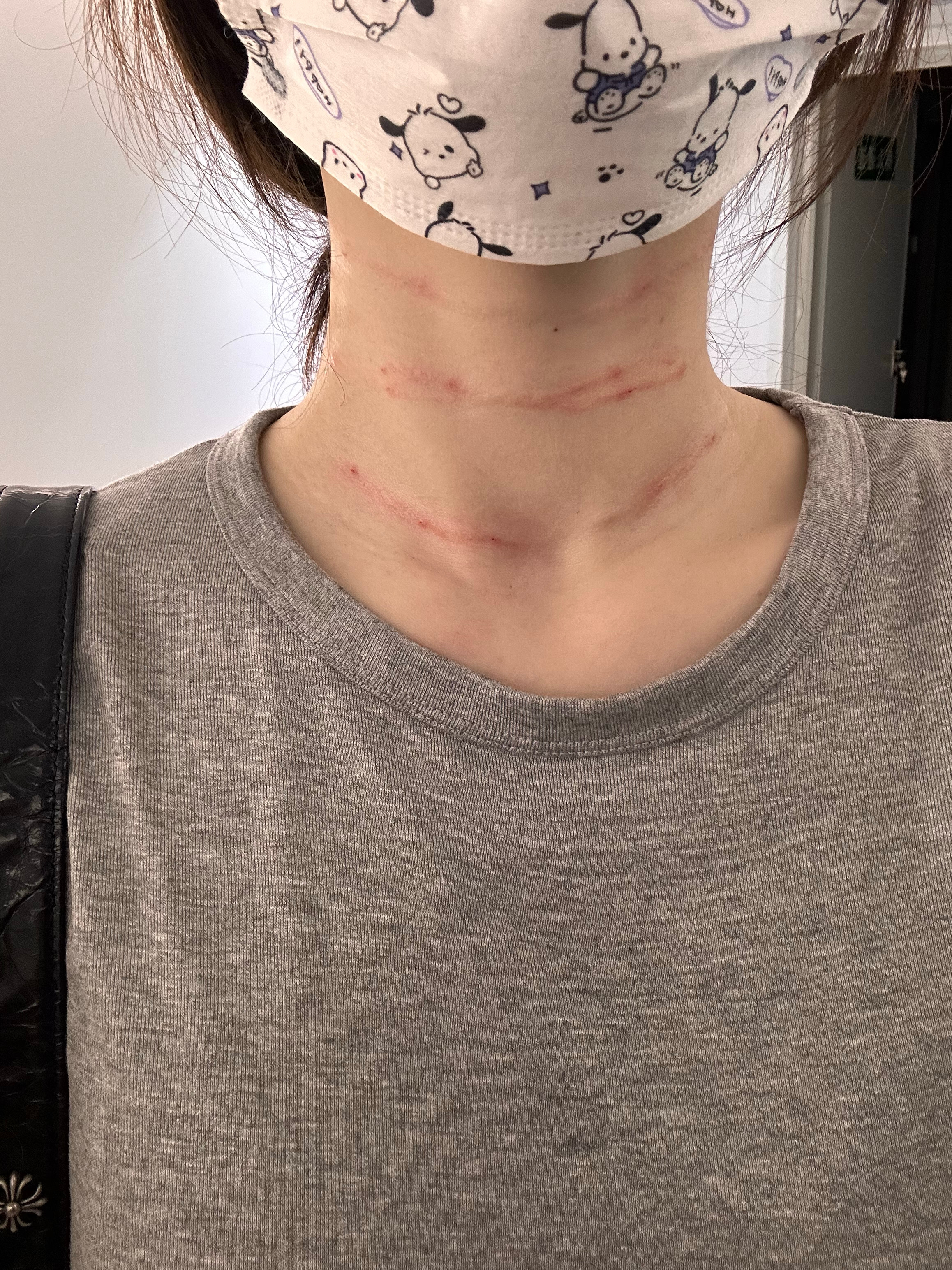 打完咯 这次希望能保持的久一点！刚打的时候我发现医生好像用的钝针钝针会有很明显用