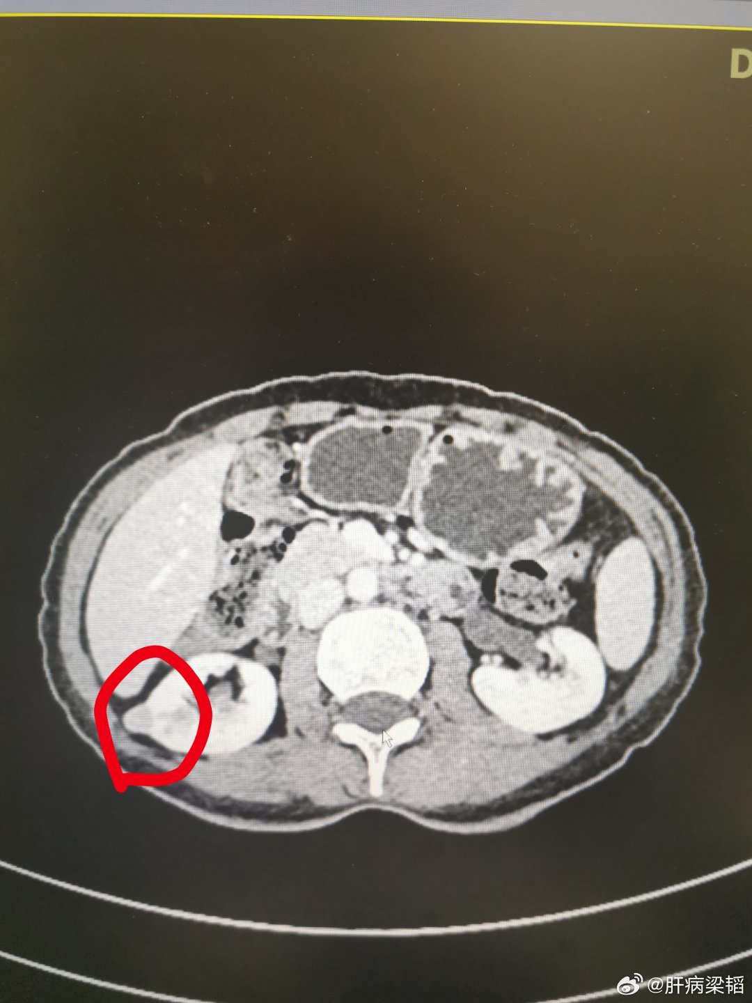 造影剂快进快出：在增强CT / 增强MRI里，描述的是病灶的血供特点：1. 快进