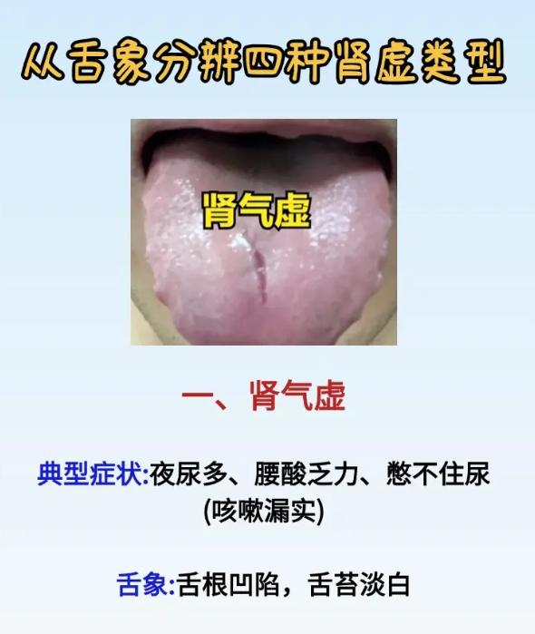 看舌识体质：四种肾虚类型一测便知