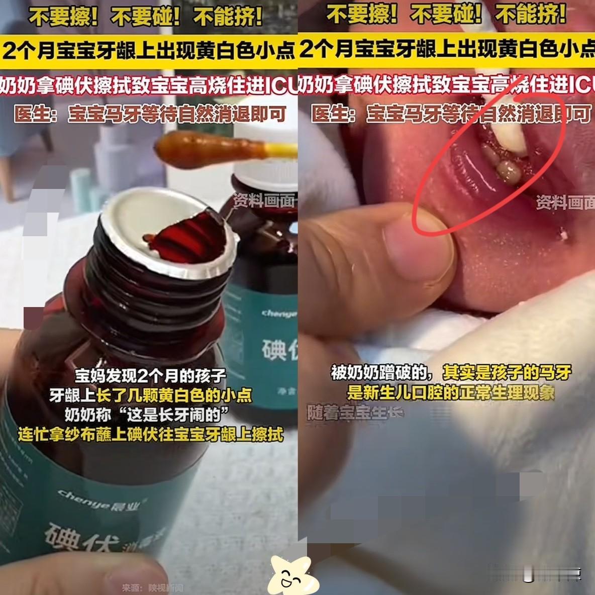 陕西西安，一位宝妈在家里带2个月的孩子，偶然发现孩子的嘴里好像有个东西，经验老道