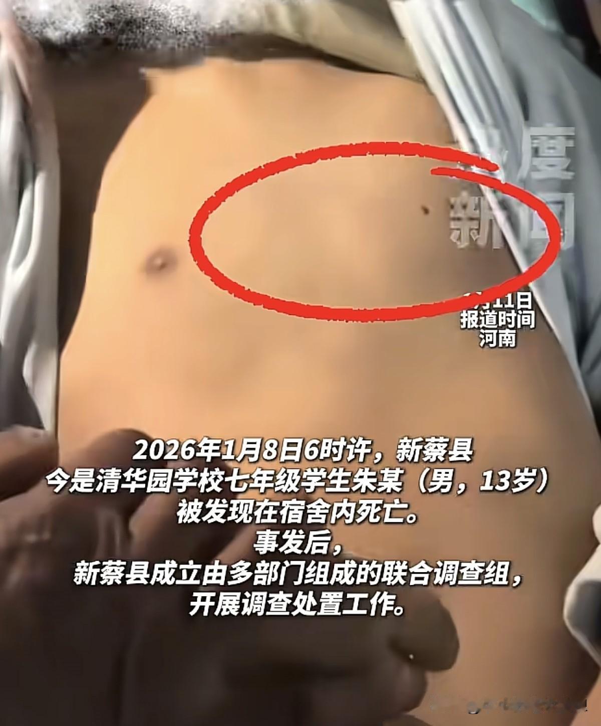 河南新蔡县13岁男孩在学校宿舍离奇死亡事件引起了热议，现在有了最新的进展，左边胸