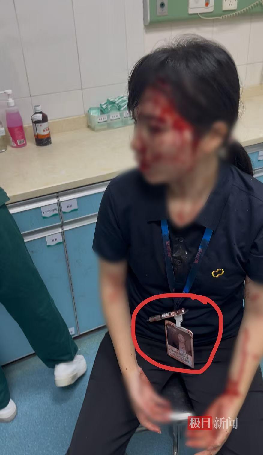 “男子持水杯砸伤女同事被刑拘”后续：脸部缝20多针的女子已出