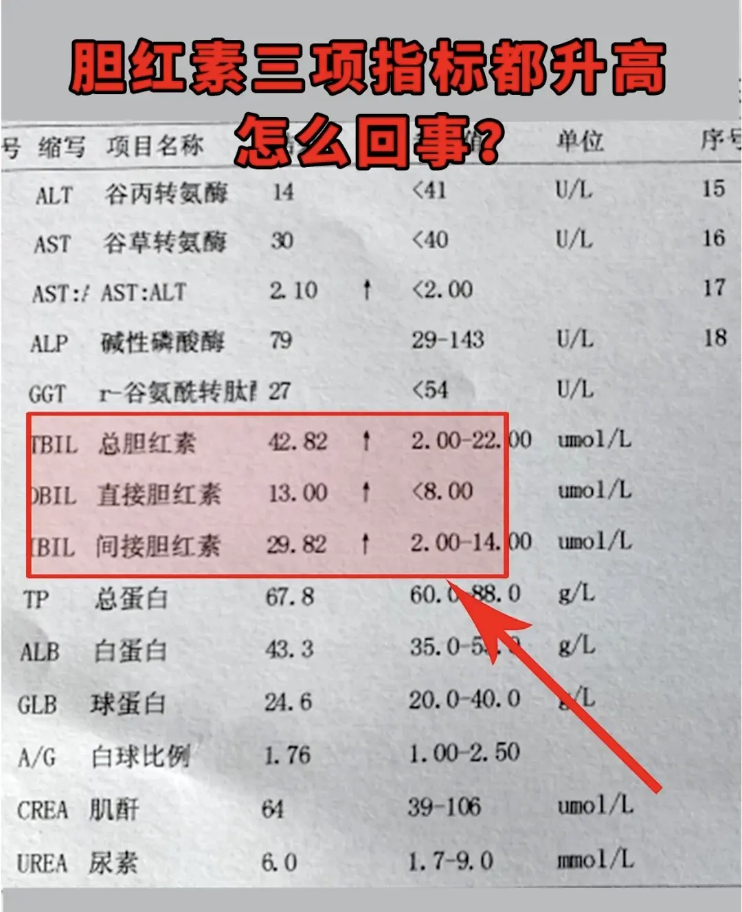 三个胆红素都偏高，可能是由肝脏疾病、溶血相关疾病等因素造成的。建议及时...