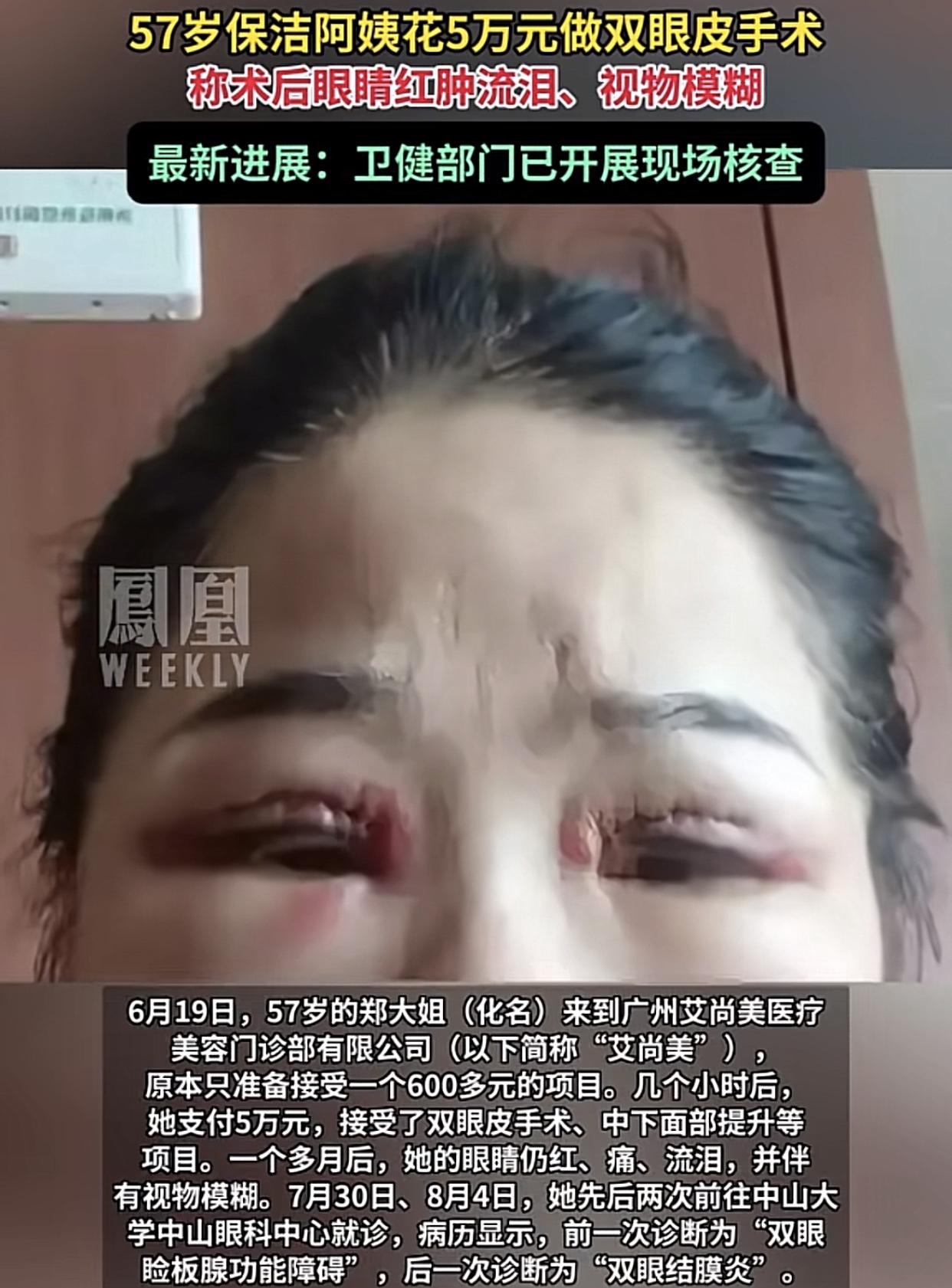 本想花600割个双眼皮，殊不知，等从美容院出来时，却花了 5 万！

广州一名5