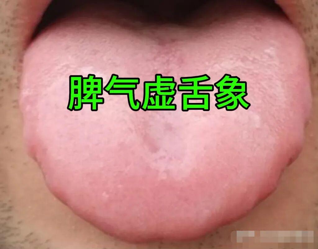解析四种脾虚舌象，看看你属于哪一种？
① 脾气虚弱
舌象特点：舌体显得较为胖大，