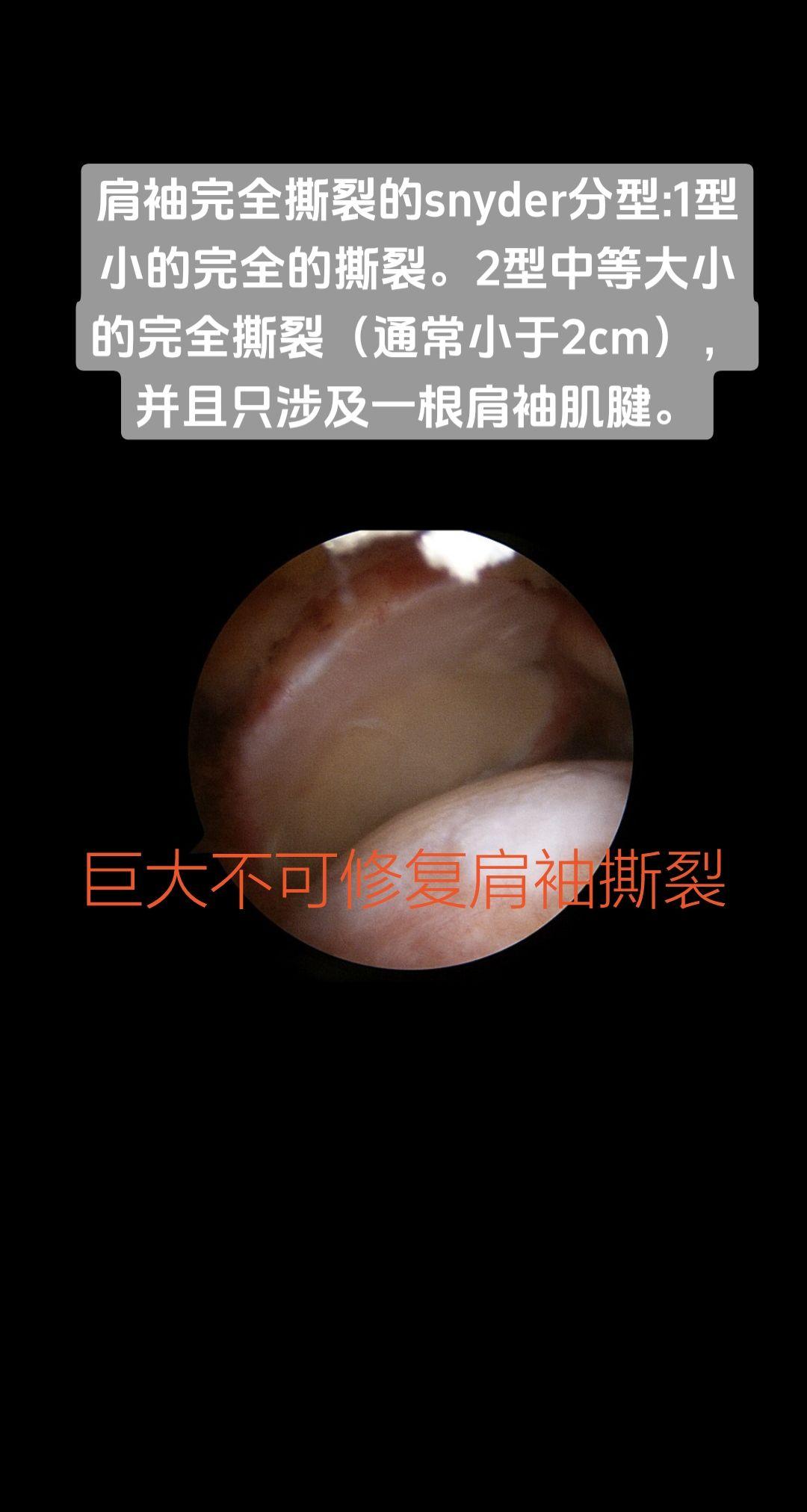 肩袖撕裂的分型。