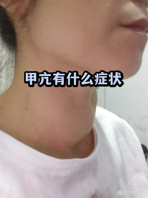 确诊甲亢也不用过度恐慌，只要及时就医接受规范小事，每一个不起眼的不适感，都是身体