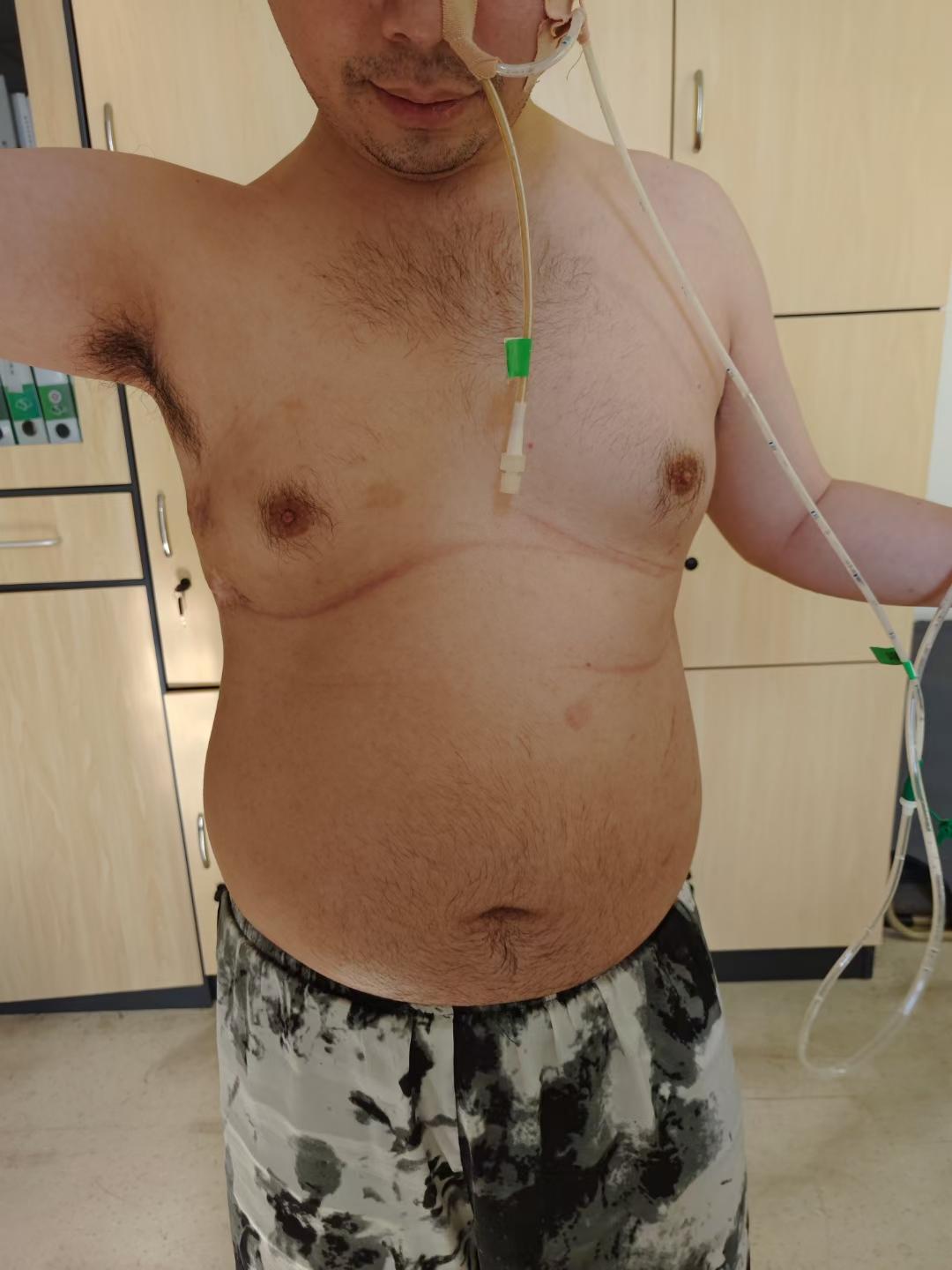 支气管胸膜瘘已是世界难题，同时合并食管瘘更是无解。小伙右肺下叶切除术后...