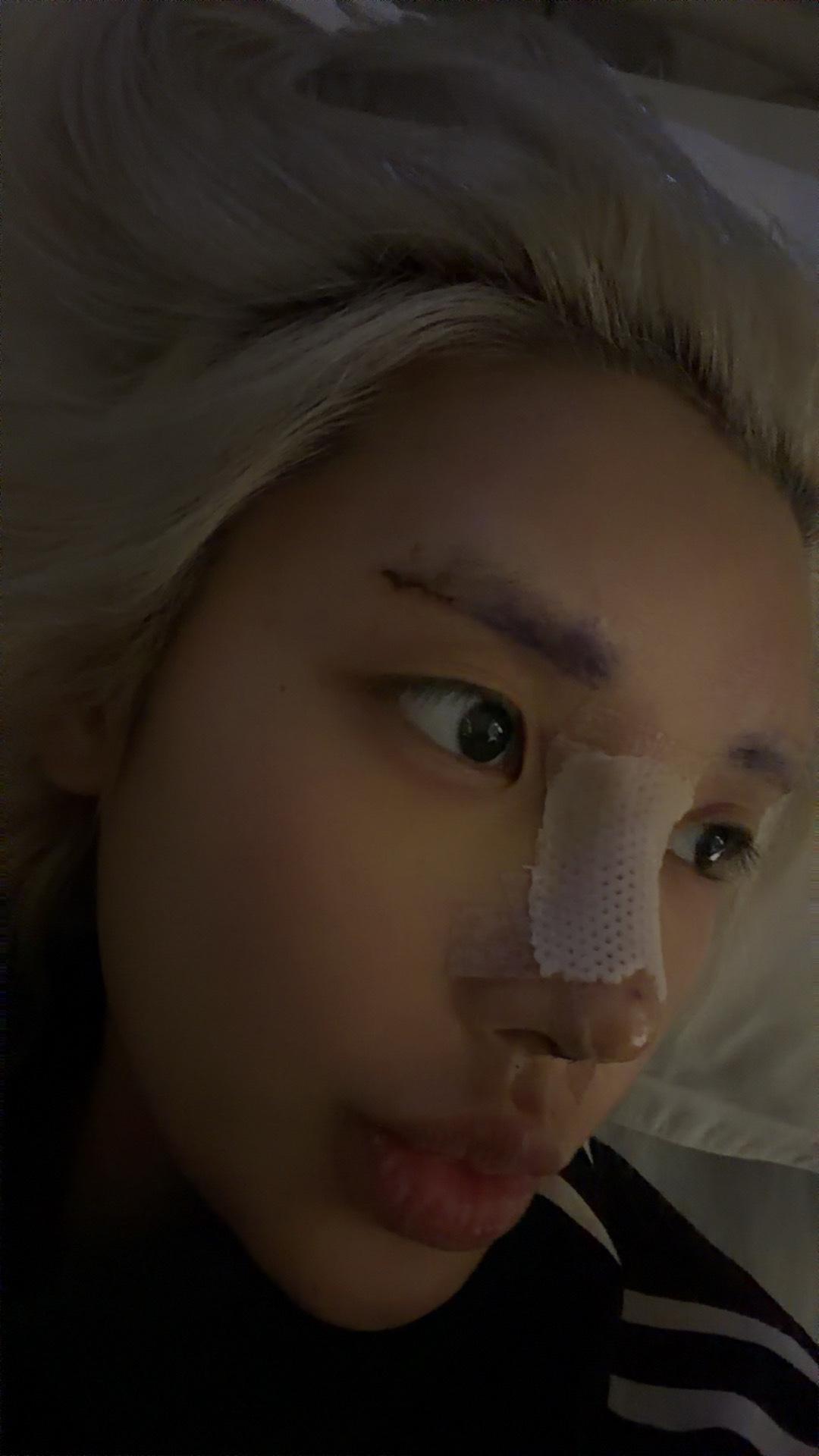 明天是真真正正的要拆线回家了 ​​​