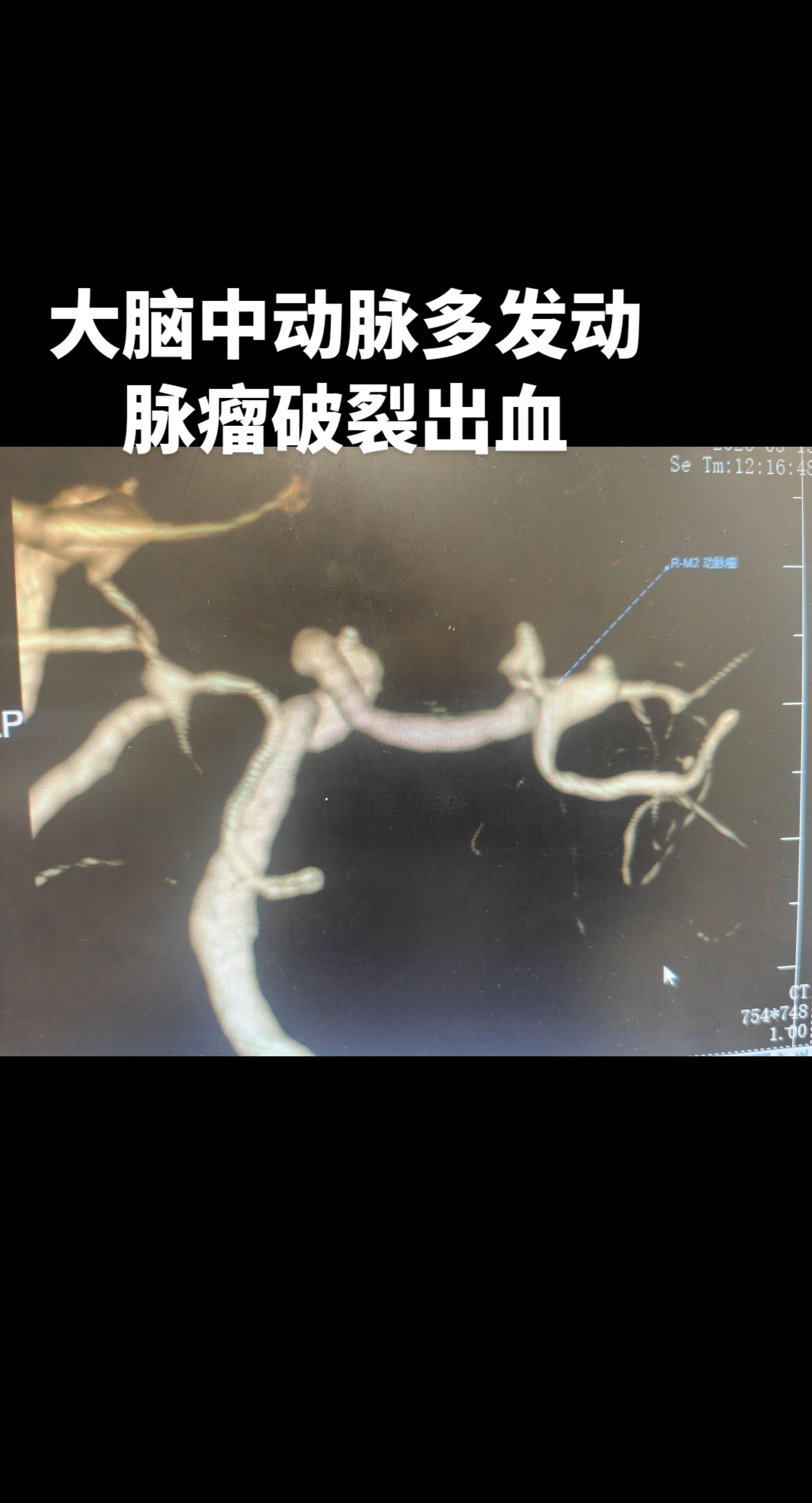 脑动脉瘤破裂出血，是脑科最危险的一种疾病