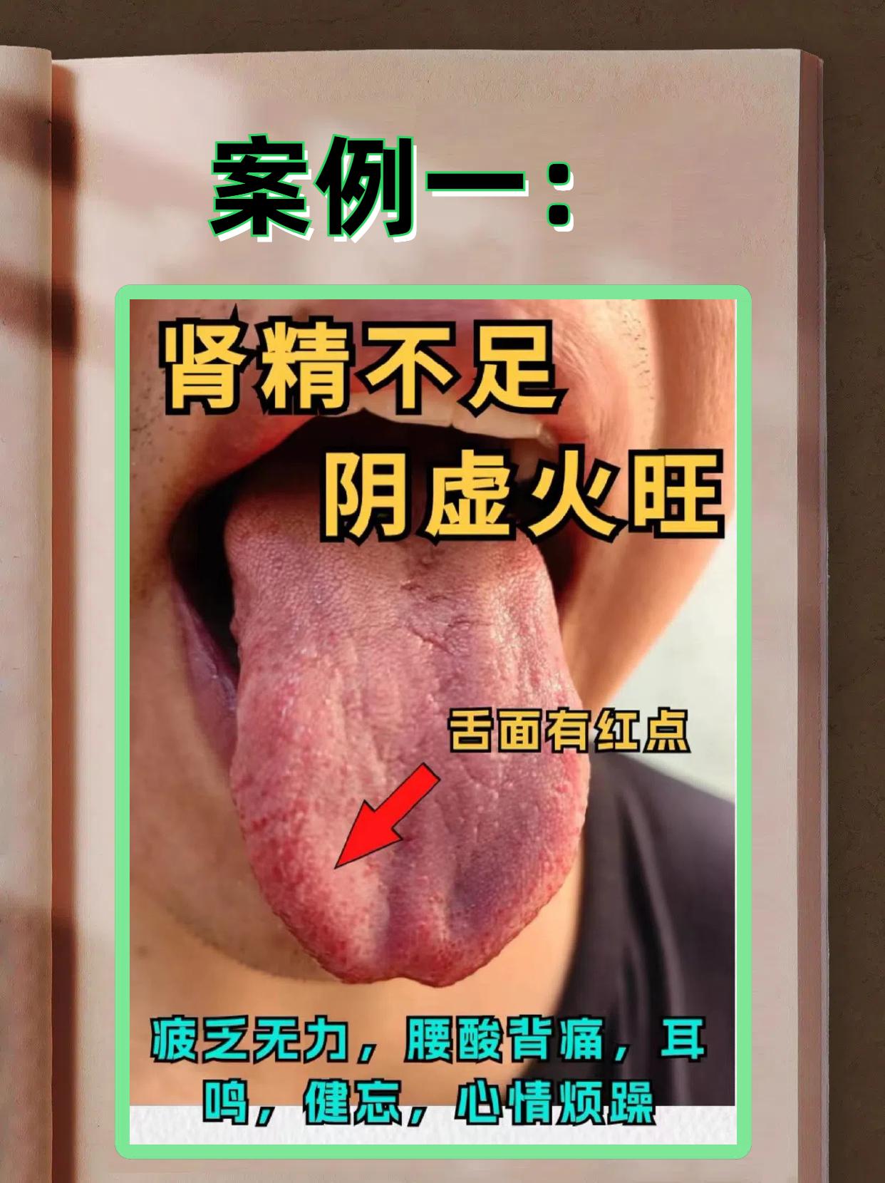 这个月每日坚持抽空看舌象第12天，今天争取看完100个舌象！

给大家分享一下我