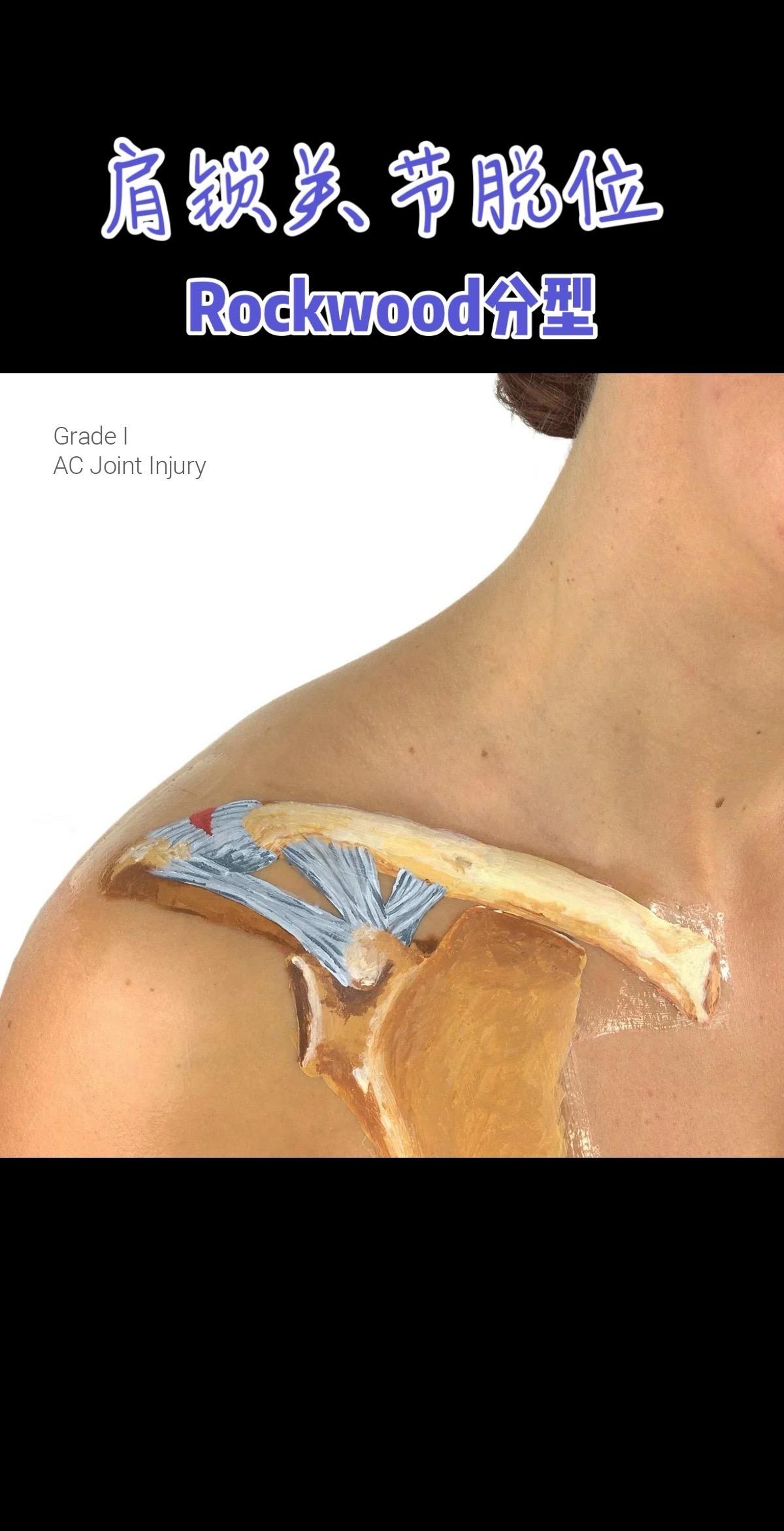 肩锁关节脱位。Rockwood分型。