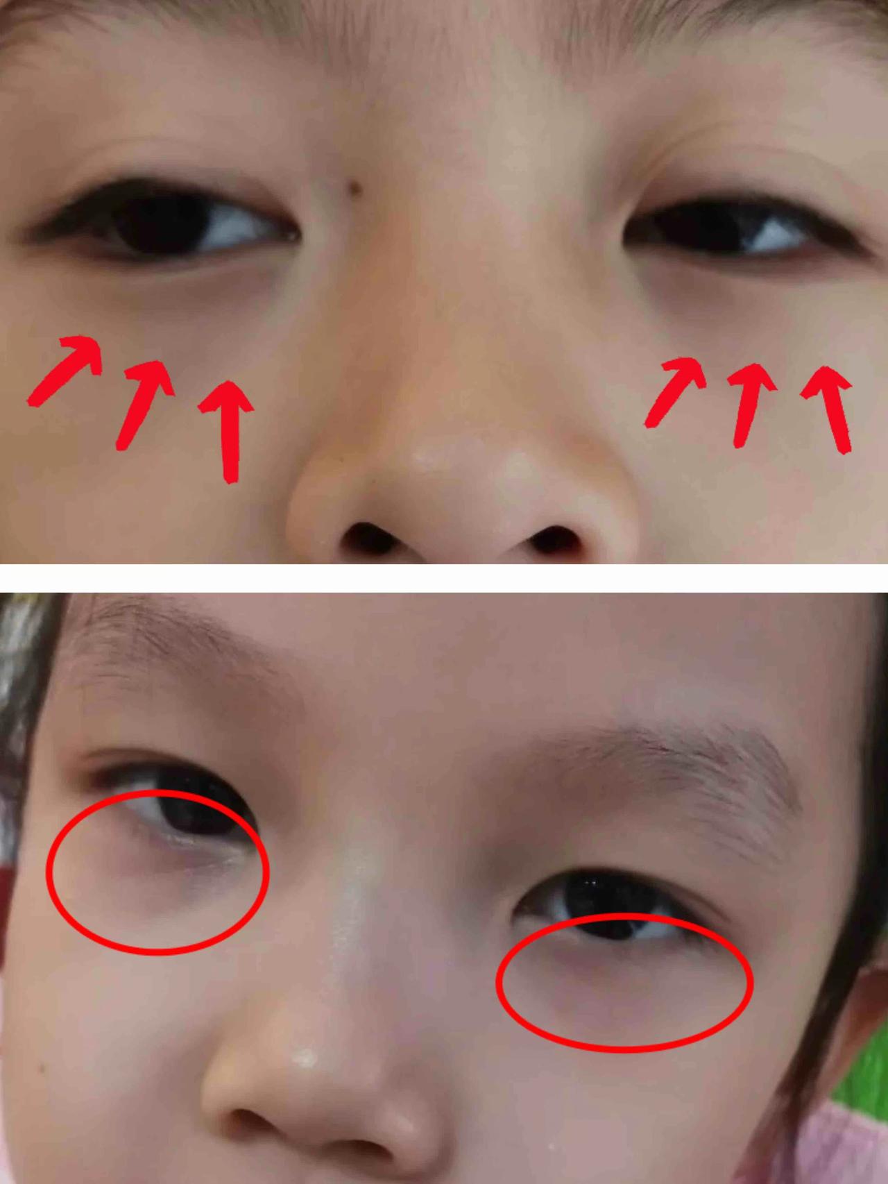 门诊上很多家长问我，孩子睡眠挺充足的，为什么下眼睑长期发青？顶着两个大眼袋，像是