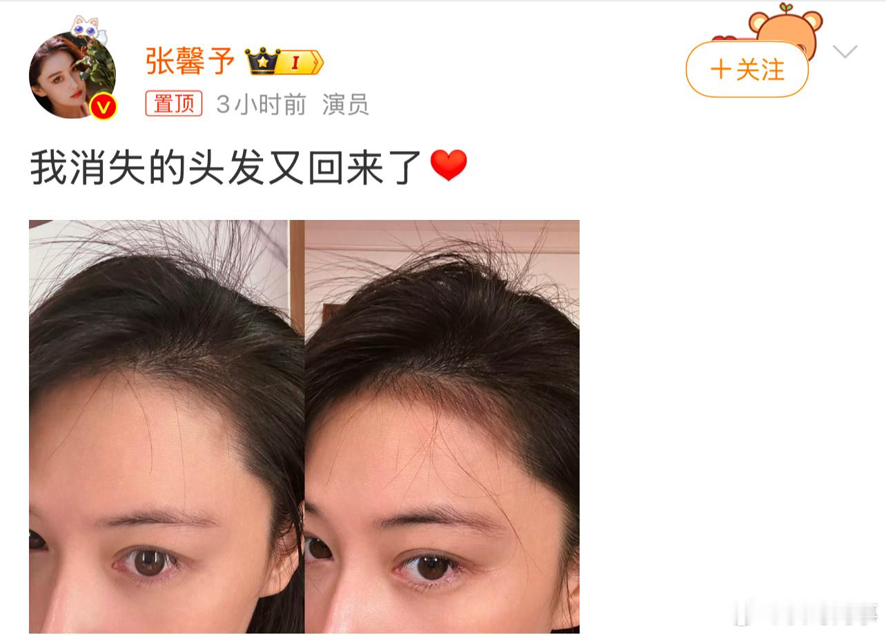 张馨予发文：我消失的头发回来了…… 