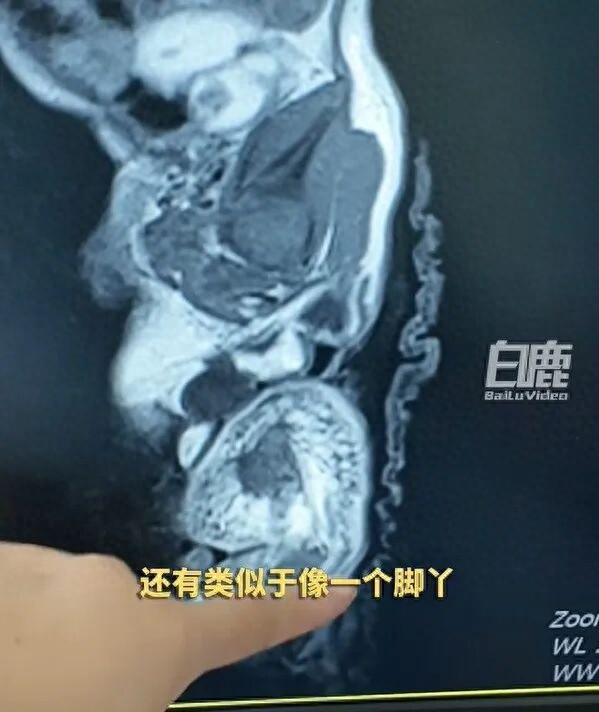 “活久见！”8月27日报道，陕西西安，一女子产检时，发现腹中胎儿臀部有个巨大包块