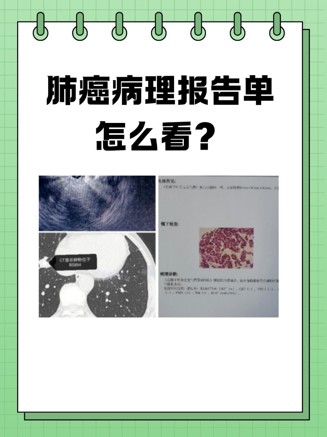 肺癌病理报告单怎么看?