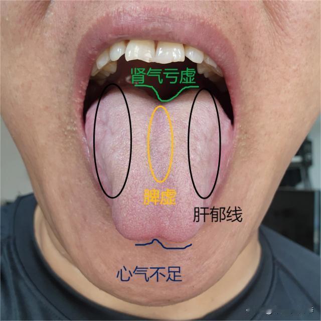 评论区舌象实战分享：有一种虚，叫做肝郁脾虚，这个病人的舌头就很典型
舌象分析：
