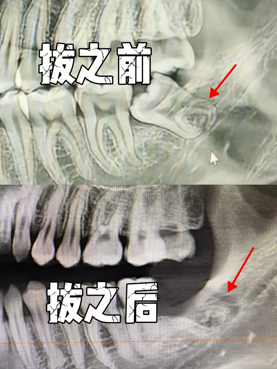 实习生看了都摇头的智齿长啥样？