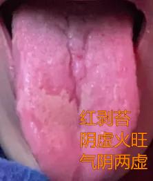 起立困难，易疲软！今天分享一个红剥苔的舌象，在男科方面，这种苔象说多不多，说少也