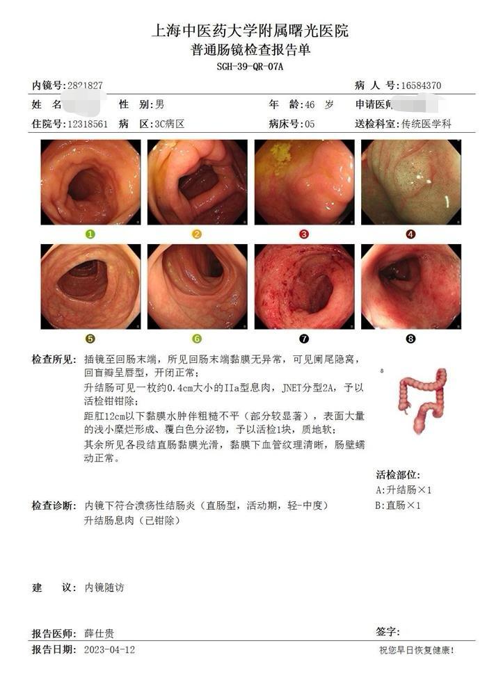 黏膜愈合是为了达标治疗，减少复发。溃疡性结直肠炎，就好比你的肠道里有伤口。
伤口一直不好，是不是要流血流脓？
服药治疗要把伤口愈合，不是天经地义吗？
伤口愈合了，是不是就不容易复发？哪怕你吃了点辛辣刺激的，或者喝酒等。
当然这种愈合，是依靠有效的药物去愈合的，而不是你自己好的。
这个病人就是一个典型，治疗了以后，脓血便消失了，他就以为好了，人也长胖了10斤，平时也不监测大便常规＋隐血＋粪便钙卫蛋白。自信满满和我说肠镜会好的，结果今天一查，果然还有一些炎症活动，这下他知道其中的道理了。